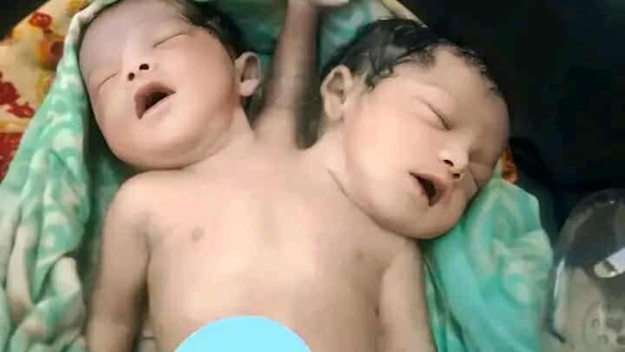  দুই মাথা-তিন হাতওয়ালা শিশুর জন্ম