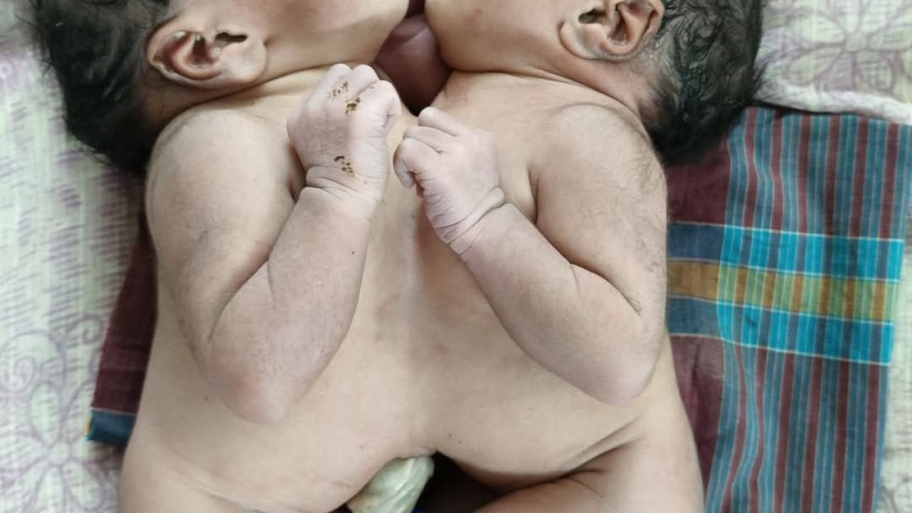 পত্নীতলায় পেটে জোড়া লাগা যমজ শিশুর জন্ম